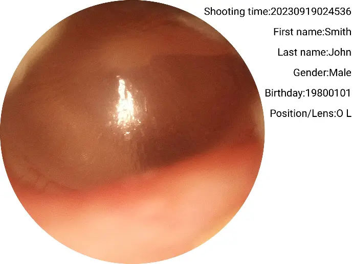 Eardrum captured with the RCS-100 Otoscope lens