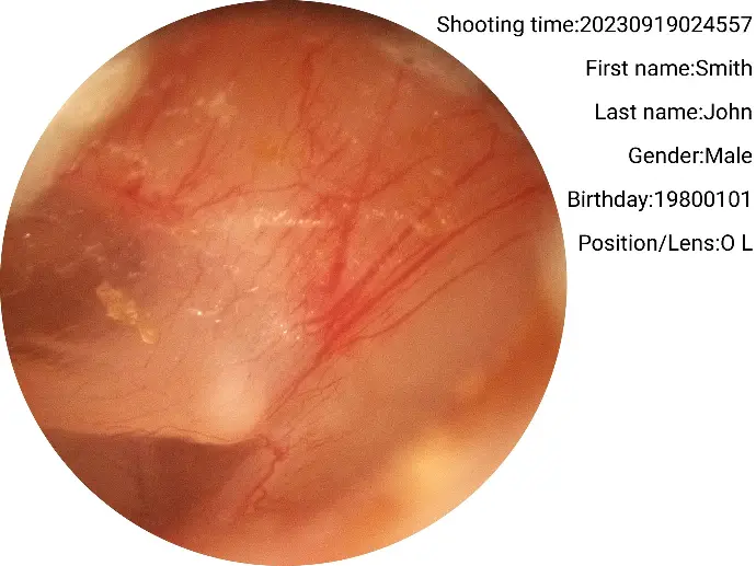 Pars flaccida captured with the RCS-100 otoscope lens.