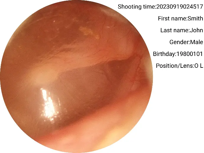 Upclose of the eardrum showing the umbo and malleus handle