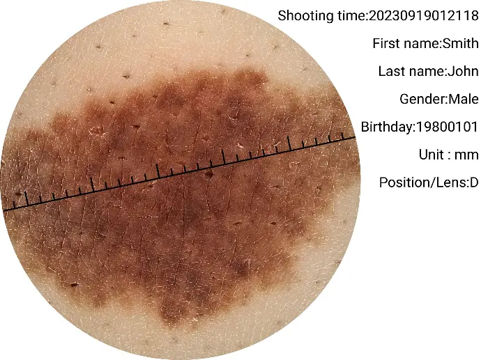 Upclose of a large birthmark captured with the RCS-100 dermatoscope lens.