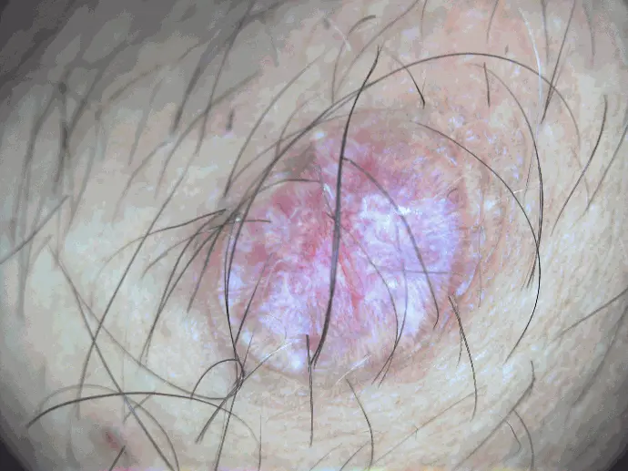 Closeup of  round scar captured with the DE605 general exam camera