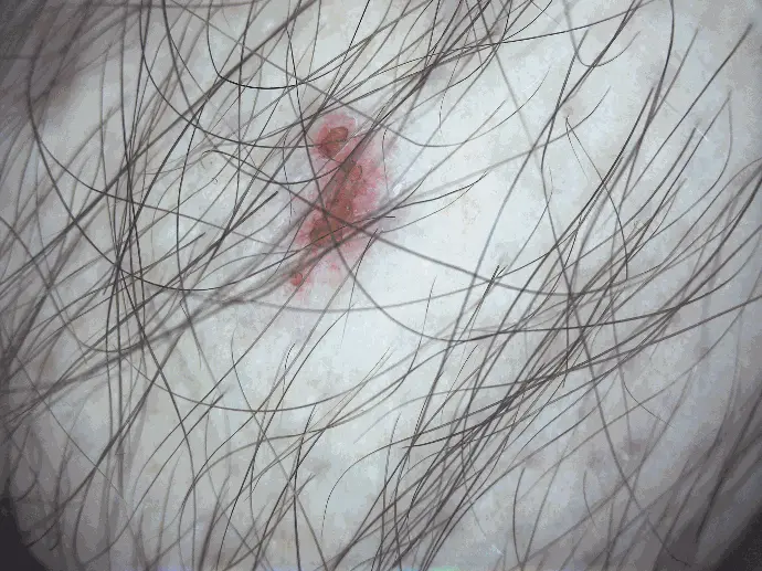 Small scab captured with the DE605 exam camera