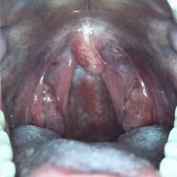 Throat and tonsils during intraoral exam