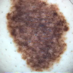 Large birthmark being checked during dermoscopy