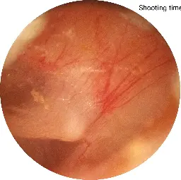 High quality closeup of the eardrum
