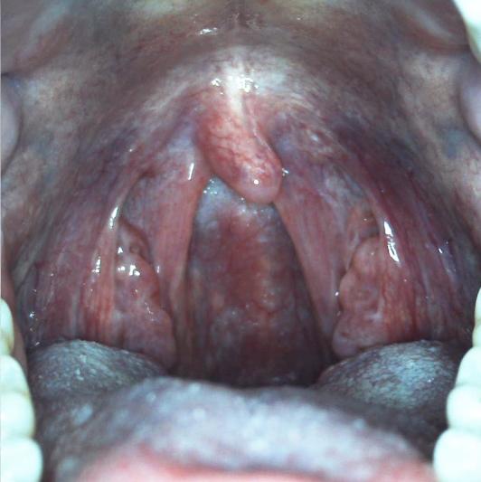 Throat and tonsiles captured with the DE605