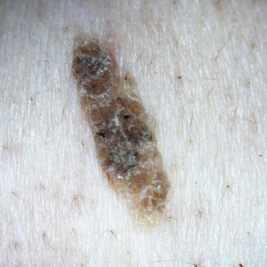 Smaller skin lesion captured with the DE605