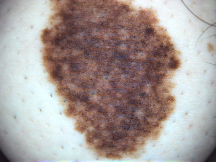Large birthmark captured with the DE605